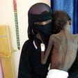 In Yemen, 14 million people stand at the brink of famine