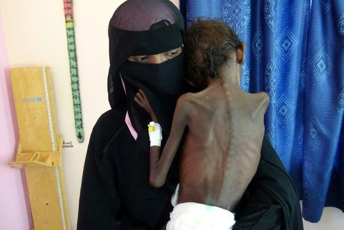 In Yemen, 14 million people stand at the brink of famine