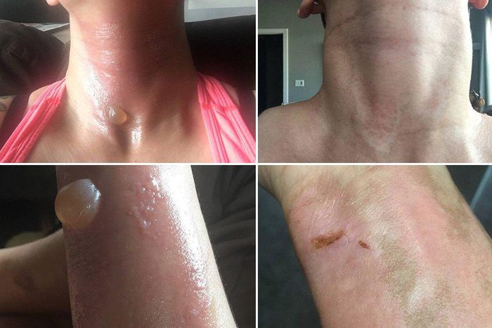 ___6610307___https:______static.pulse.com.gh___webservice___escenic___binary___6610307___2017___5___1___22___This-Woman-Got-Horrible-Burns-From-Using-Natural-Oils-Before-Indoor-Tanning2