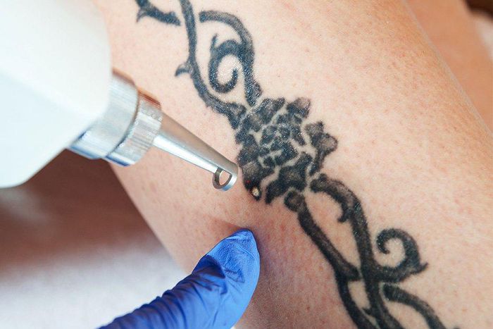 ___6719683___https:______static.pulse.com.gh___webservice___escenic___binary___6719683___2017___5___22___19___what-to-know-tattoo-removal