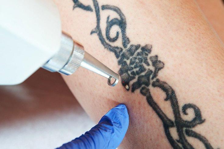 There are creams and balms that promise to lighten or erase a tattoo.