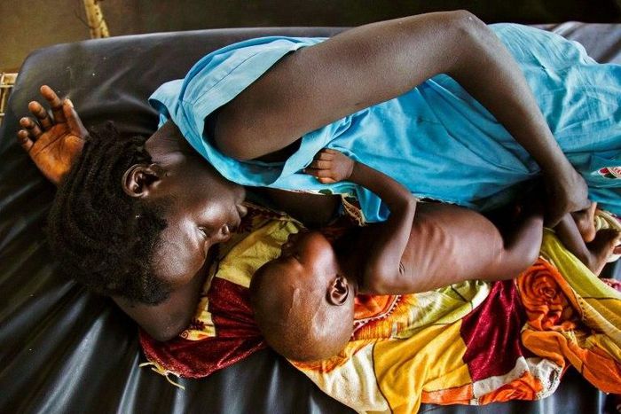 A mother breastfeeds her child who suffers acute malnutrition, at the clinic run by Doctors Without Borders (MSF) in Aweil, northern Bahr al-Ghazal, South Sudan