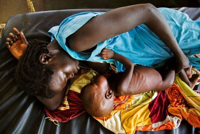 A mother breastfeeds her child suffering from acute malnutrition at a clinic run by Doctors Without Borders (MSF) in Aweil, northern Bahr al-Ghazal, South Sudan
