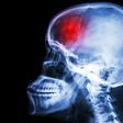 ___6536798___https:______static.pulse.com.gh___webservice___escenic___binary___6536798___2017___4___16___11___young-men-at-risk-for-stroke