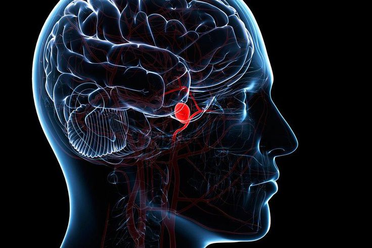 brain aneurysm