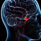 brain aneurysm