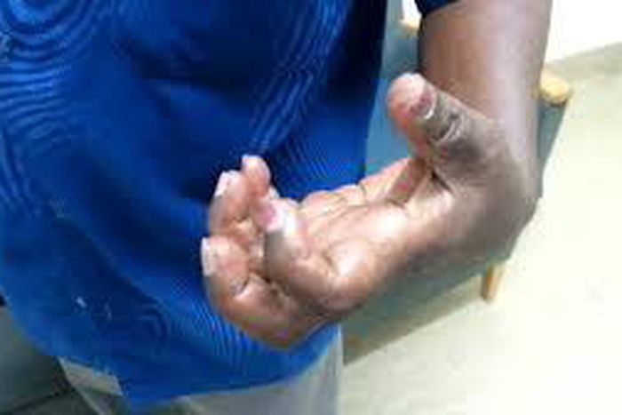 Effect of stroke on the hand.