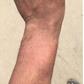 Bruises from the alleged police assault