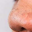 Blackheads are caused by oils and dead skin cells