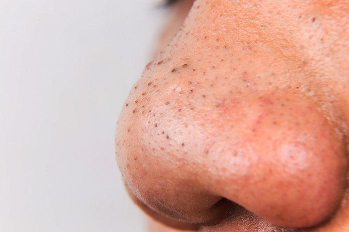 Blackheads are caused by oils and dead skin cells