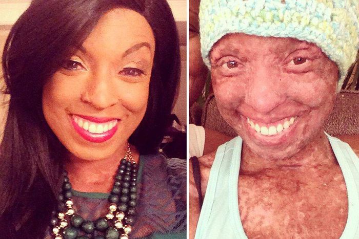 ___6663567___https:______static.pulse.com.gh___webservice___escenic___binary___6663567___2017___5___11___19___This-Womans-Skin-Melted-Off