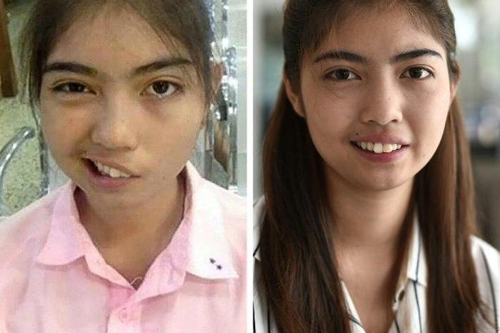 A photo combo by Paveena Foundation in 2016 and AFP's Lillian Suwanrumpha in 2017 of Thai schoolgirl Naruedee Jotsanthia who was left facially disfigured after a schoolteacher who threw a mug at her head