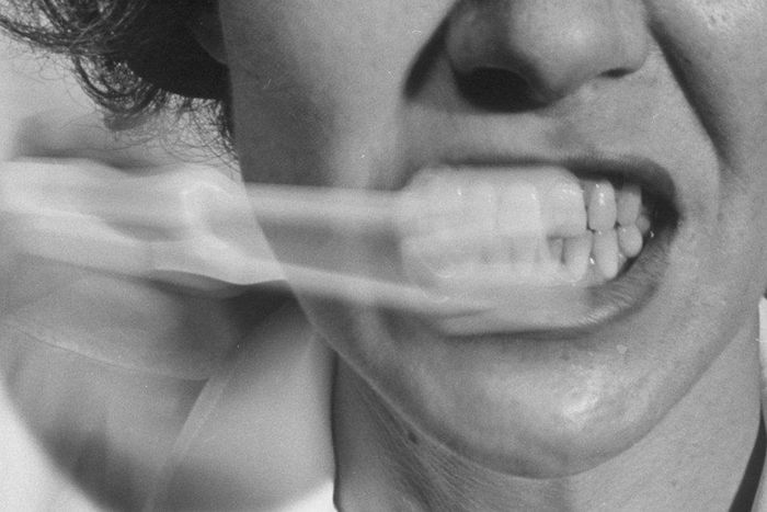 White spots on the teeth.