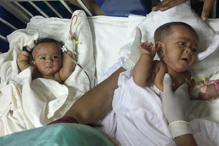 Tofa and Tahura, ten-month-old twins who were born conjoined at the spine and rectum, were separated by a team of two dozen doctors Tuesday in Dhaka