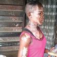 Victoria Emmanuel was bathed with acid while celebrating her birthday