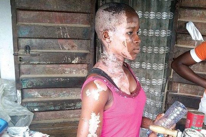 Victoria Emmanuel was bathed with acid while celebrating her birthday