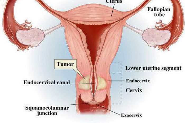 Cervical Cancer
