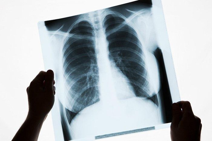 This Is Why Men Need to Be Screened For Lung Cancer More Than Women