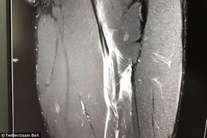 Usain Bolt's hamstring injury
