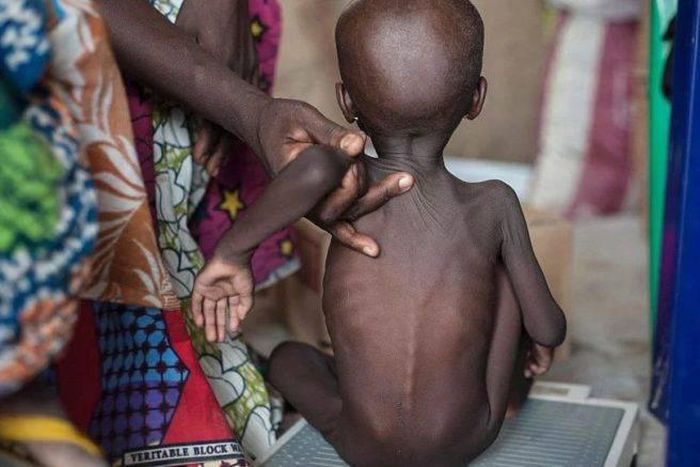 Children malnourished in the North