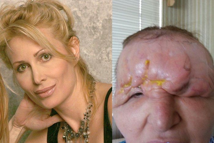 I got injectable fillers, and they disfigured my face