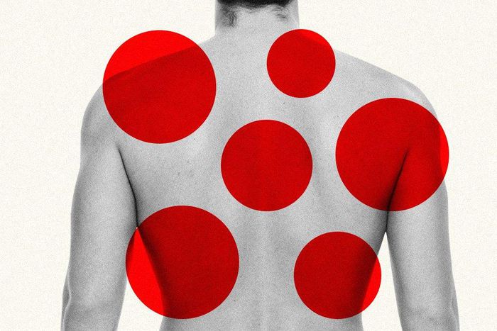 pay someone to pop pimples on your back