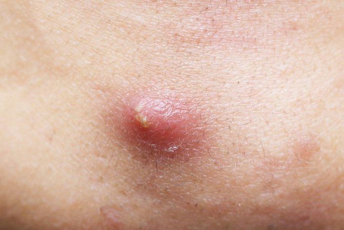 World Haemophilia Day