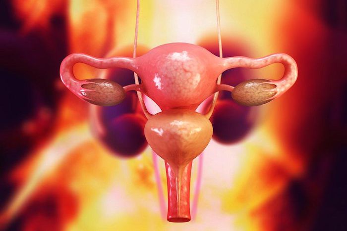 Are your periods irregular? You could have this syndrome and not even know it