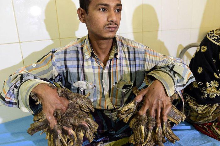 ‘Tree Man’ has surgery to remove bark-like warts on his hands