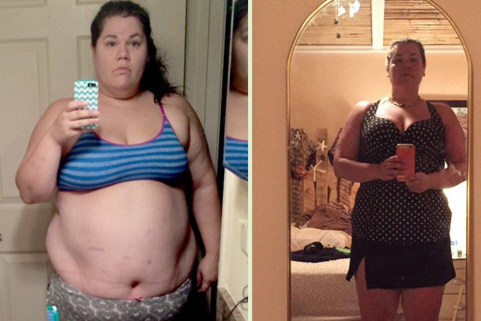 '9 things I wish I knew about gastric bypass surgery before I had it’