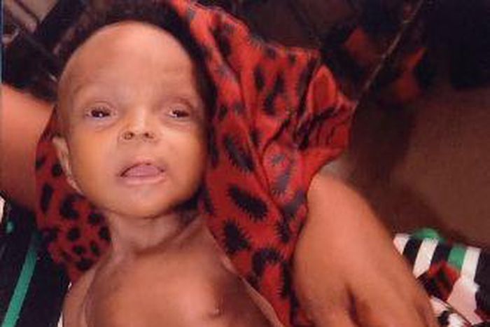 Child born without anus or genitals
