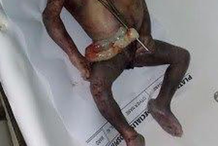 The deceased newborn twins