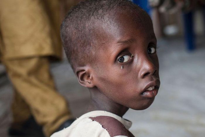Malnourished boy at an IDP camp in Borno