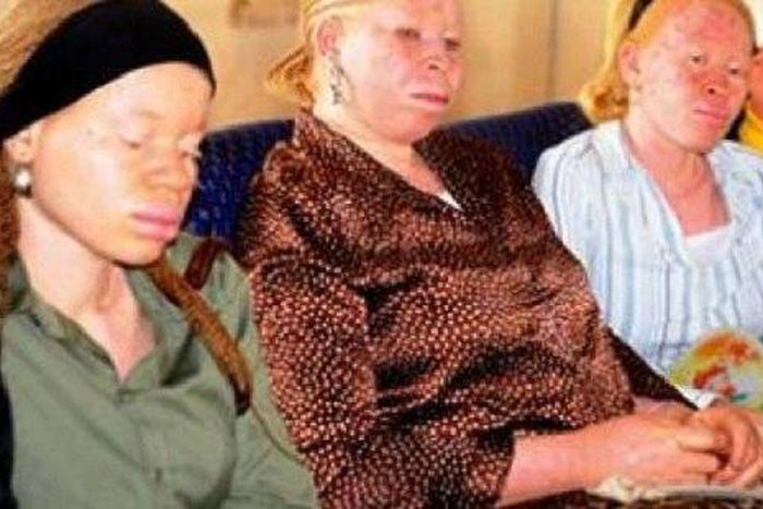 Members of the Albino Foundation of Nigeria