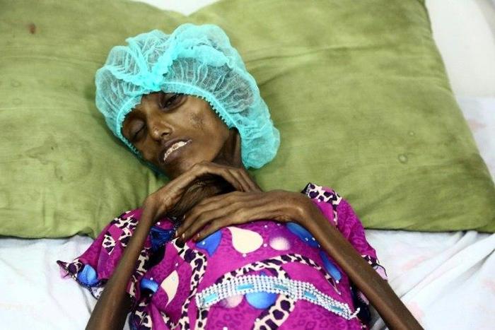 Saida Ahmad Baghili, an 18-year-old Yemeni woman lies in bed at the al-Thawra hospital in Hodeidah where she is receiving treatment for severe malnutrition on October 25, 2016