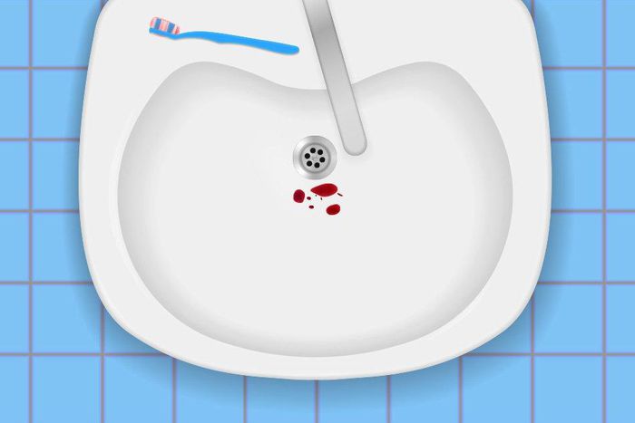 5 reasons why your gums are bleeding when you brush