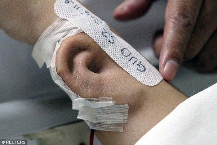 An artificial ear is seen growing on the arm of a patient whose name is Ji.