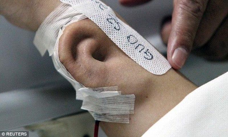 An artificial ear is seen growing on the arm of a patient whose name is Ji.