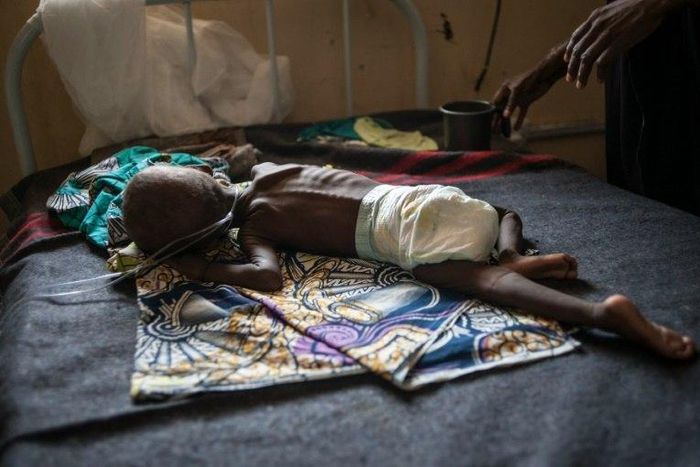 A young child suffering from severe malnutrition is treated at the In-Patient Therapeutic Feeding Centre in Maiduguri, northeastern Nigeria, on September 17, 2016