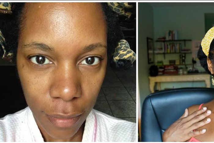 6 things you should know about lip fillers