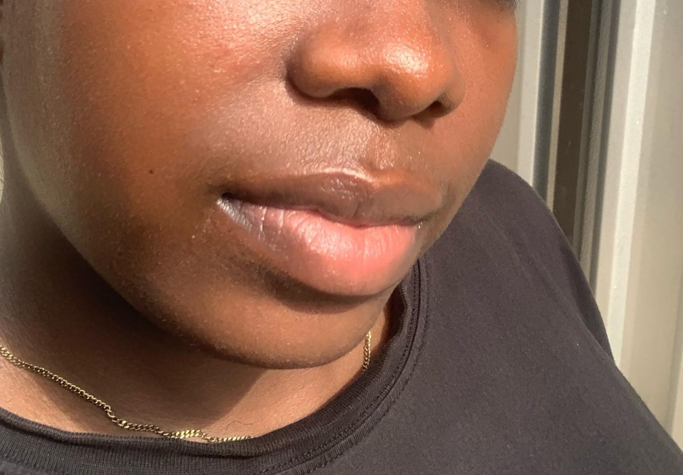 My cheeks before using Everyday Gentle Foaming Face Wash Pump