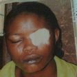 Woman docked in Lagos for biting off friend's eyelid