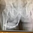 The victims x ray photo