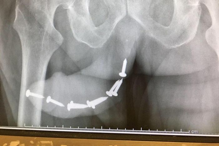 The victims x ray photo