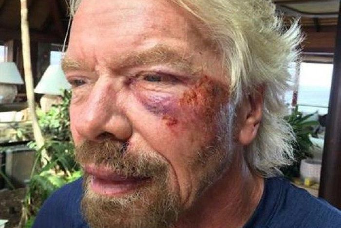The injured billionaire tycoon, Richard Branson