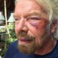 The injured billionaire tycoon, Richard Branson