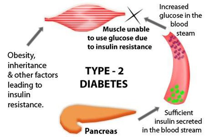 Diabetes type 2