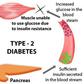 Diabetes type 2
