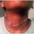The rope burn marks