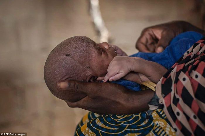 Malnourished children in Nigeria's IDP camps 